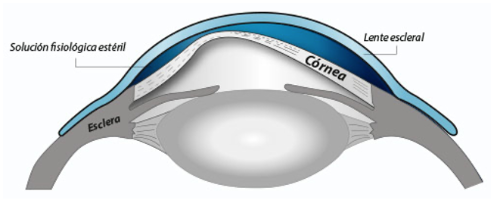 Lentilla escleral discount